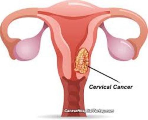 Cervical Cancer