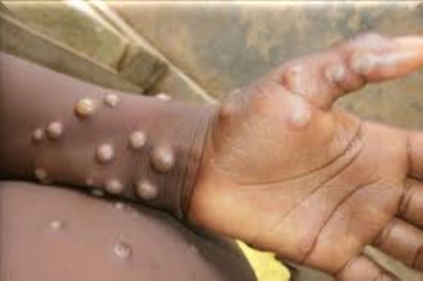 MPox
