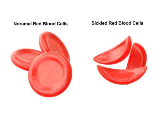 Rwanda NCD Alliance launches nationwide sickle cell awareness campaign
